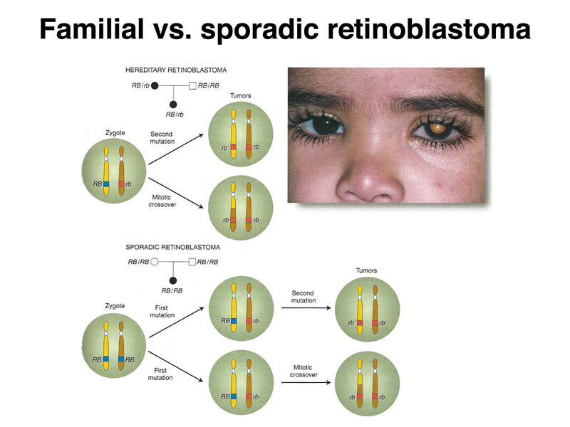 retinoblastoma