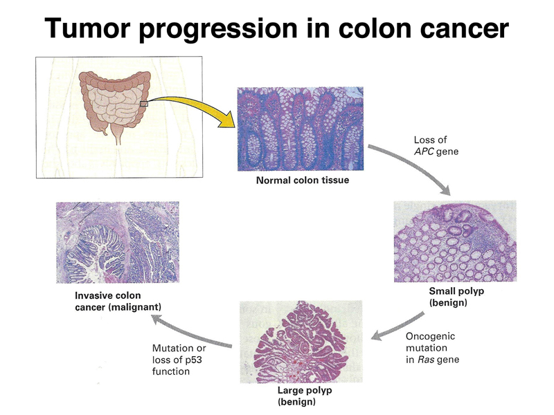 Colorectal cancer progression - Cancer colon progression