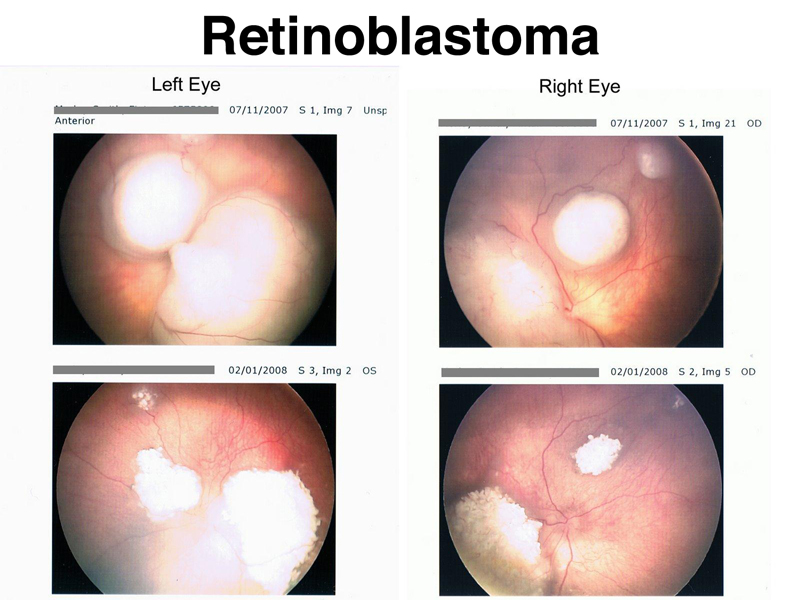 retinoblastoma