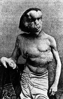 Joseph Merrick